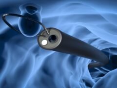 recurrent-colonic-loop