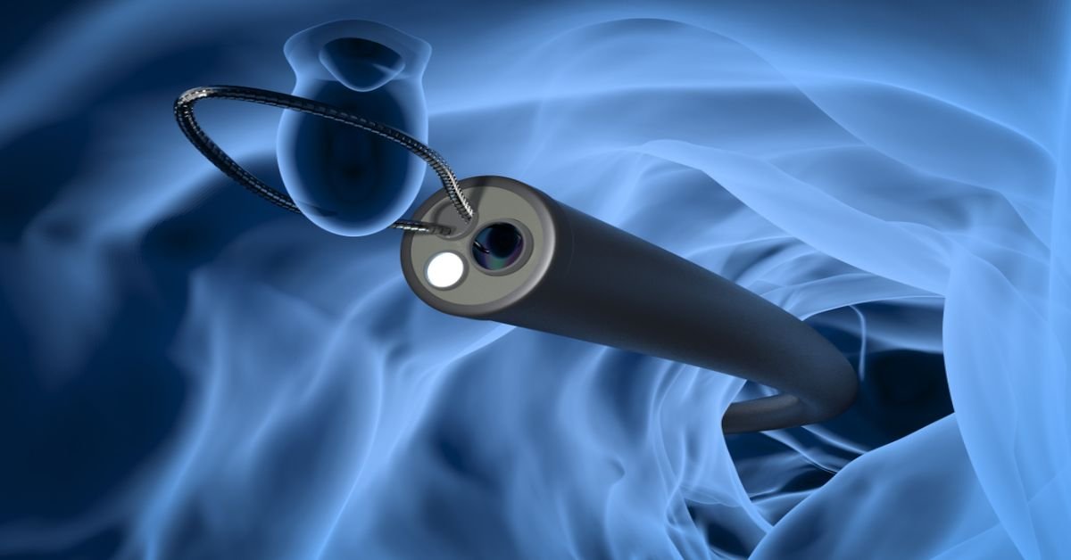 recurrent-colonic-loop